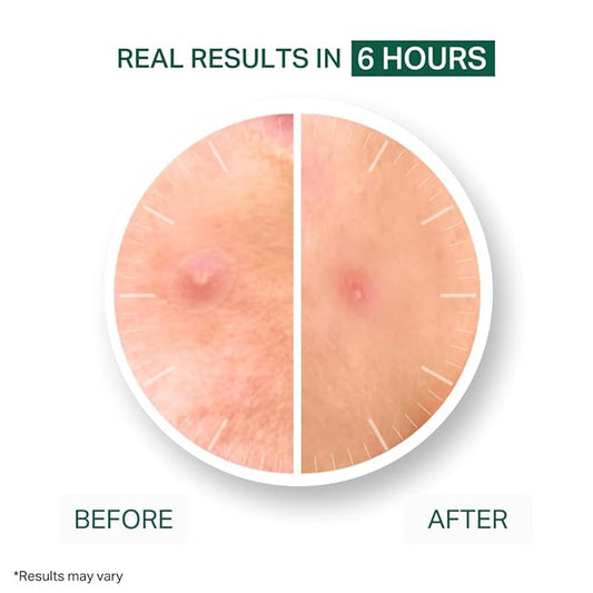 Y’OUR Improving Acne Patches: Ultra-thin Hydrocolloid Pimple Patch for Face; Purifies & Alleviates Stubborn Blemishes, Promotes Healing, Effective Zit Treatment. Made in USA. 56 Count