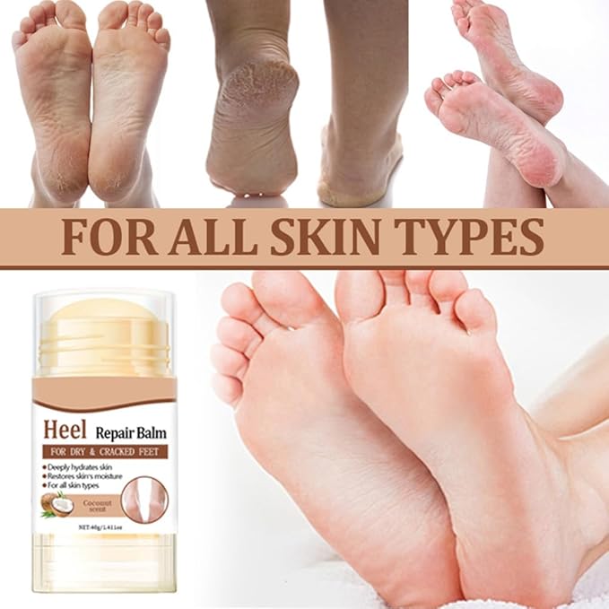 60% Urea Cream - 1.41 oz Coconut Foot Hand Cream Stick for Dry & Cracked Feet Elbows Knees Heels Hands, Hydrates & Nourish Foot Care for Softening and Moisturizing, Removing Calloused Skin