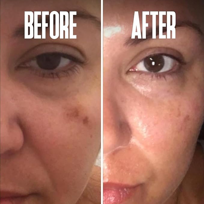 Dark Spot Corrector, Dark Spot Remover for Face - For Stubborn Dark Spots Serum, Dark Spot Remover with Kojic Acid, Alpha Arbutin, Mulberry Extract, Brightening Discoloration Correcting Serum