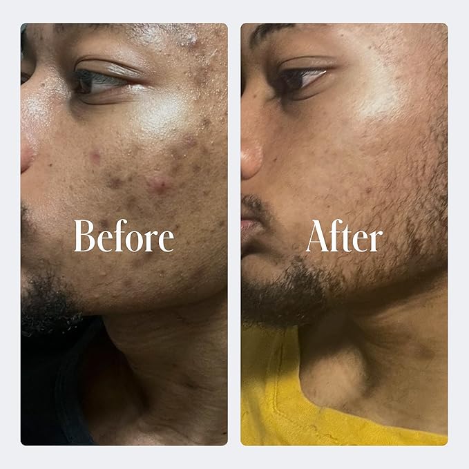 Geologie Sensitive Skincare Set for Men & Women | 1-Month Gentle & Effective Daily Skin Routine | Acne, Oily Skin, Dark Spots | Face Wash 2-Pack, Retinol Face Cream, SPF15 Moisturizer & Eye Cream