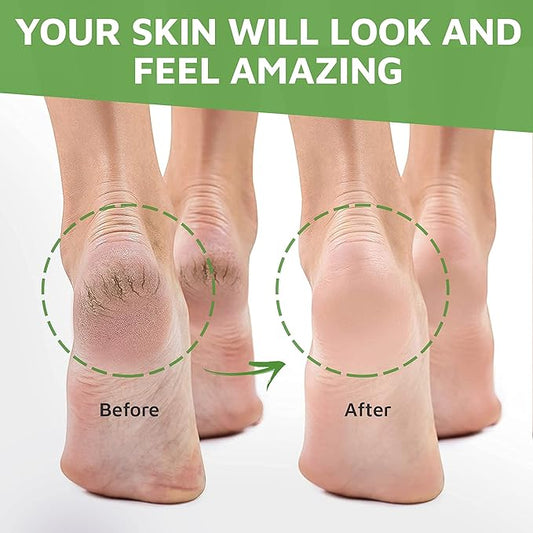 Urea Cream 40 Percent for Feet, Formulated by Doctors, Foot Cream for Dry Cracked Heels, Foot Callus Remover, Rehydrates Dry, Rough, Dead Skin on the Feet, Hands, and Elbows, Free Pumice