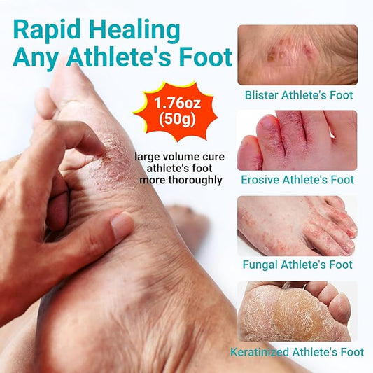Athletes Foot Treatment Cream, Maximum Strength for Athlete's Foot (Tinea Pedis), Itching, Blister, Burning, Cracking, Scaling, Beriberi,Natural Herbs Antifungal Foot Cream (2-Pack)