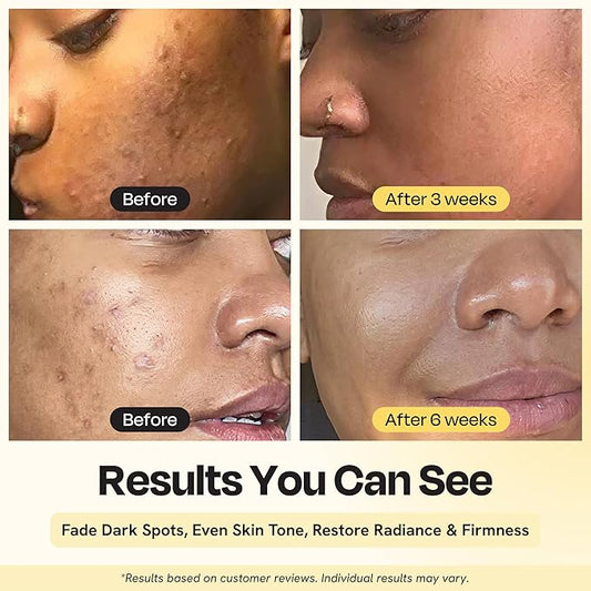 Gleamin Superactive Vitamin C Serum for Face with 15% Vitamin C, Niacinamide, Bakuchiol & Hyaluronic Acid – Skin Brightening Facial Serum for Women & Men – Dark Spot Remover & Radiant Glow – 1 fl oz