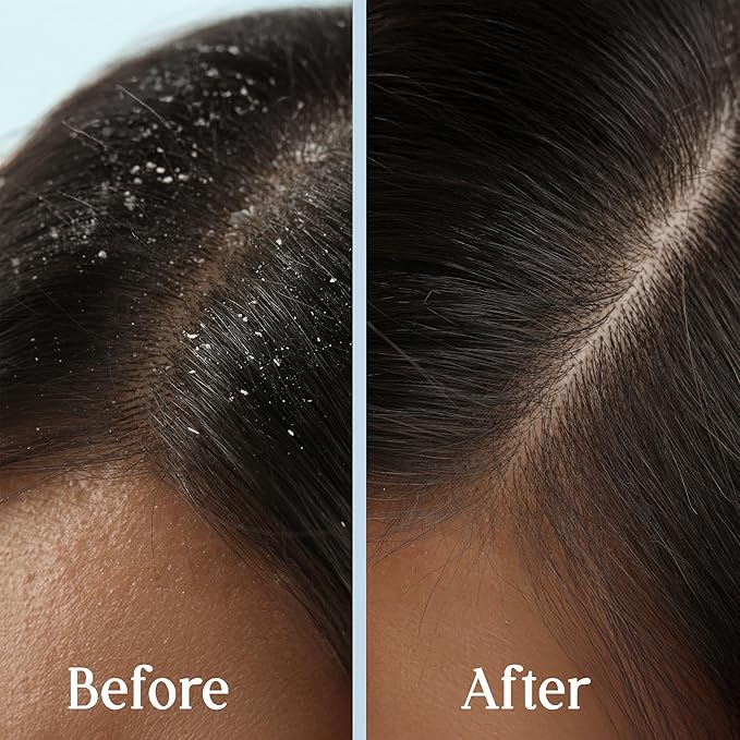 Dry Scalp Serum – Anti-Dandruff & Itchy Scalp Relief with Rosemary, Sage, Biotin & Amino Acids – Hydrating Leave-In Scalp Treatment, Vegan & Clean Formula, 1 fl oz (30 mL).