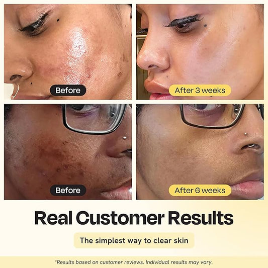 Gleamin Vitamin C Clay Mask for Dark Spots, Turmeric Clay Face Mask Skin Care, Deeply Cleanses & Refines Pores, Brightens Uneven Tone and Helps Improve Post-Blemish Scarring & Texture, Up to 20 Uses