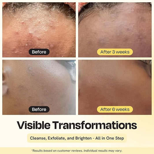 Gleamin Vitamin C Face Wash & Facial Cleanser - Cream to Foam 2% Salicylic Acid Cleanser with Paw Paw & Turmeric - Gentle Exfoliating Facewash for Women & Men, Oily & Combination Skin, 3.4 fl oz