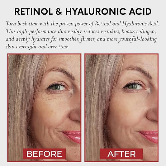 AURA Anti-Aging Retinol Serum 1% – Encapsulated Retinol, Hyaluronic Acid, Vitamin C & E, Collagen, Niacinamide – Value Pack 1.69 Fl Oz – Hydrates, Smooths & Revitalizes Skin