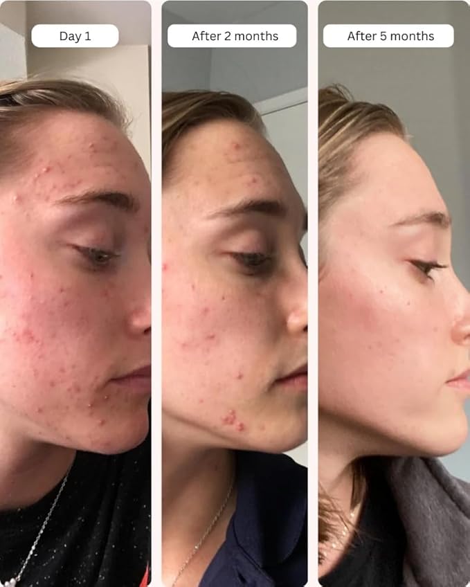 Averr Aglow Clear Skin Elixir, Face Mask Prevent Breakouts, Clear Acne & Oily Skin, Fade Scars Marks, Natural Skincare Solution, Reducer & Pores Cleanser Treatment, Natural Younger Looking Skin