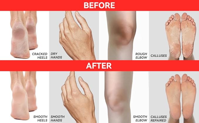 CLEAR Urea Cream 40 Percent Plus 2% Salicylic Acid (4oz) Made in USA | Urea Foot & Hand Cream Softens Cracked Heels & Dry Skin with Tea Tree & Coconut Oil - Callus & Corn Treatment