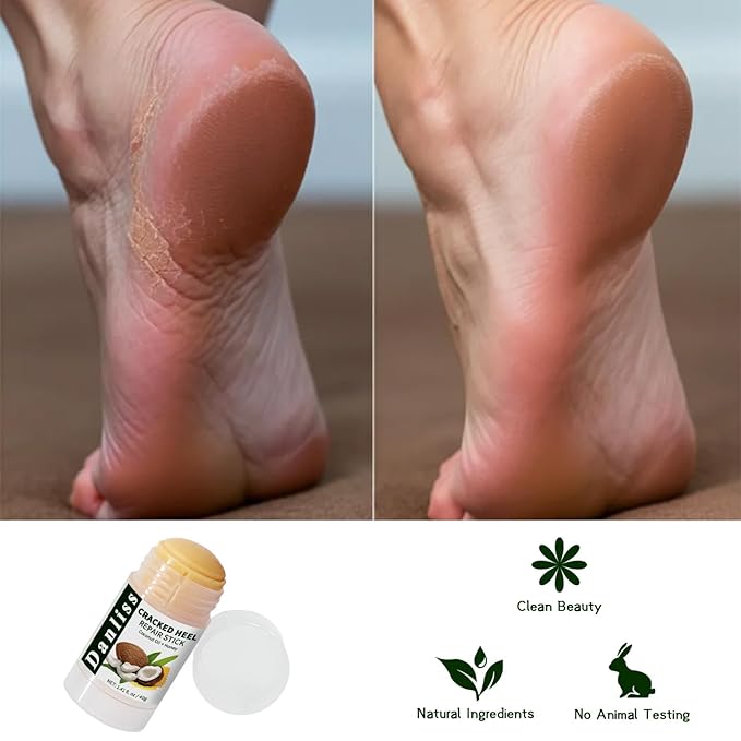 Coconut Urea foot lotion Heel Repair Balm Stick for dry cracked feet for Dry Cracked Feet Roll-on Foot Cracked Cream Softening Moisturizing Foot Care 1.14 Oz