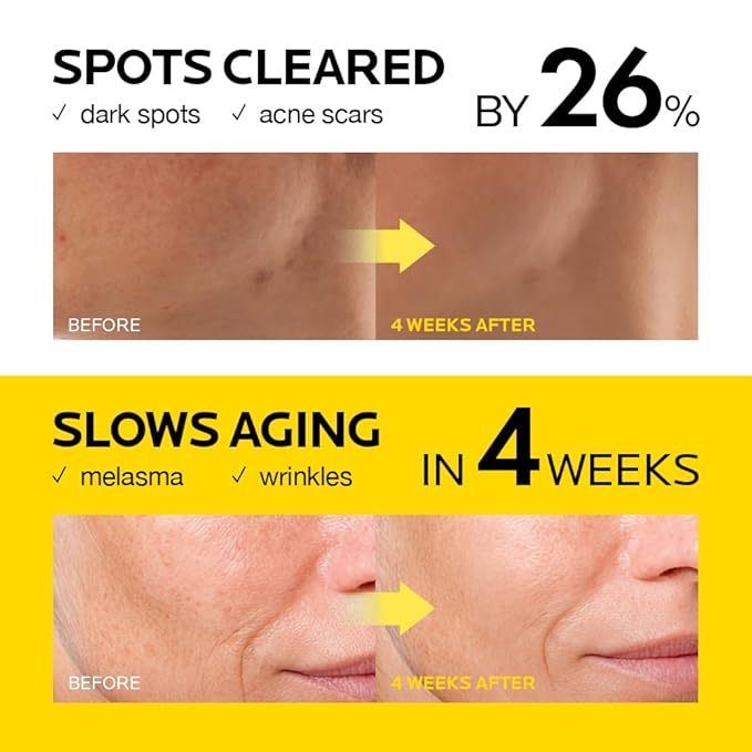 MIMUMIMU Dark Spot Remover Serum for Face | Korean Clinic Skincare - Thioctic Acid 0.01% & Niacinamide 5% | Spot Treatment for Melasma, Hyperpigmentation, Discoloration, Acne Scars | 30ml/1.01 fl.oz