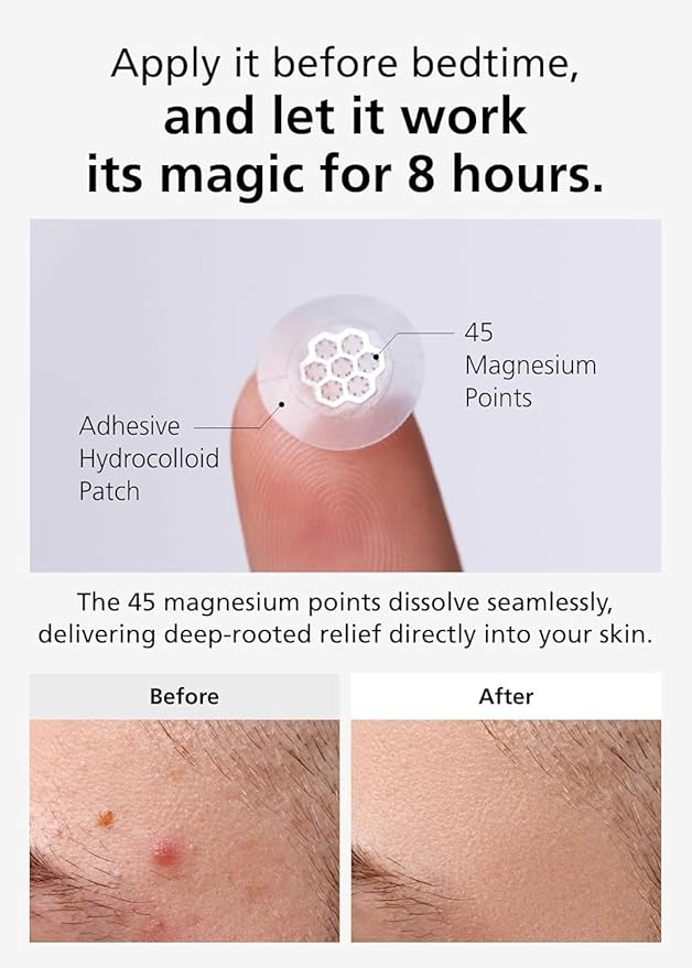 EasyDerm Magnesium Pimple Patches – Hydrocolloid Acne Spot Treatment with Ampoule & Tweezer, 10 Calming Zit Stickers by Daewoong, 이지덤, 대웅제약