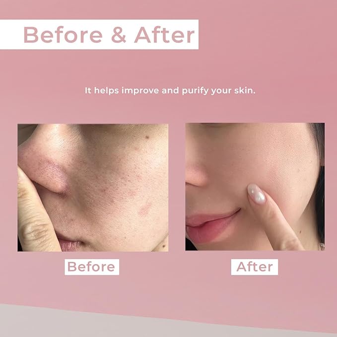 AC Bubbly Bubbly Wash-Off Pack 125g/4.4Oz, Kaolin, Deep Cleansing, Acne Prone Skin, Bubble Wash, Exfoliating, Bubble Mask, Removing Sebum and Dead Skins, Instant Bubbles Pop up