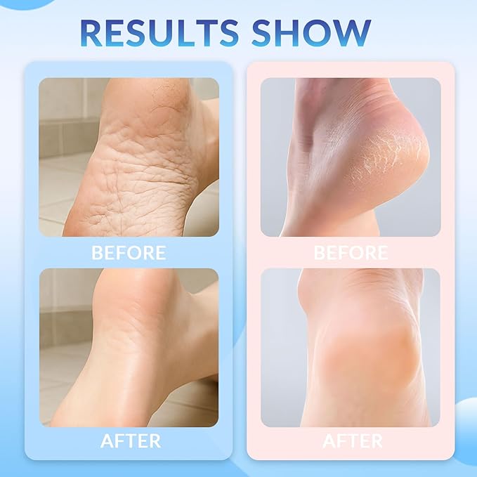 Crack Feet Prevention Stick, Vovo Angel Anti Cracked Foot Cream For Dry Heels, Moisturizing Foot Balm Stick, Remove Dead Skin And Softening Dry Skin (Pink+Blue)