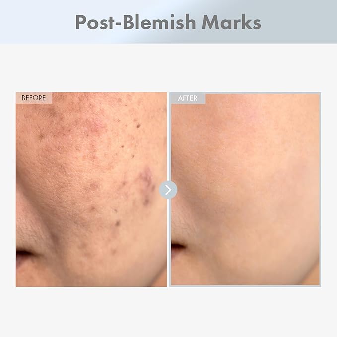 Niacinamide 15% Face Serum, 150,100ppm Niacinamide, Tranexamic acid, Dark Spot Corrector, Glass Skin, Radiant Complexion, Pore Minimizer, Even Skin Tone, Korean Skin Care, 30ml, 1.01 fl.oz.