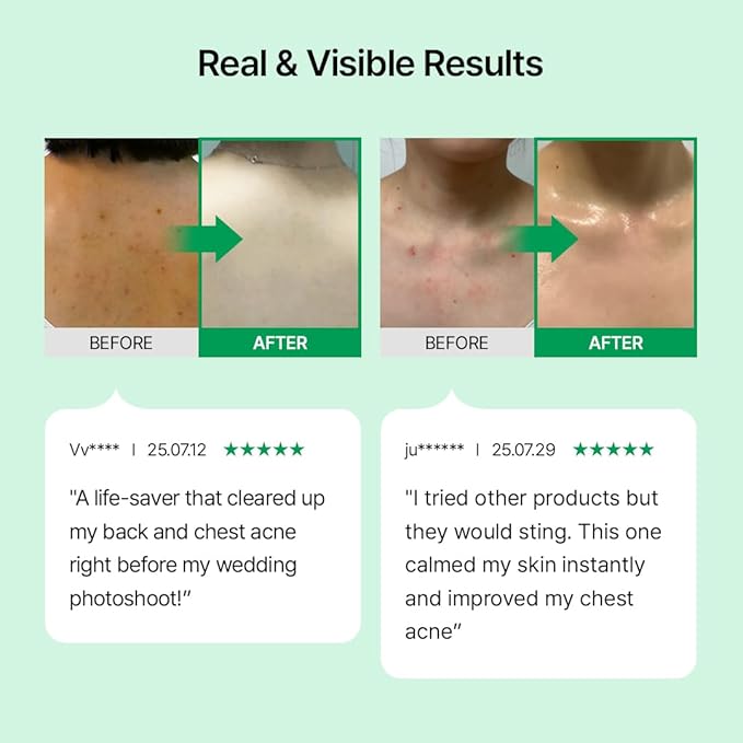 Parnell Cicamanu pH Balanced Body Mist - Centella Asiatica, Hyaluronic Acid, Ceramide, LHA, PHA, Mild Exfoliating, Soothing and Moisturizing Mist for Body, Back Acne and Bacne (5.07 Fl Oz / 150ml)