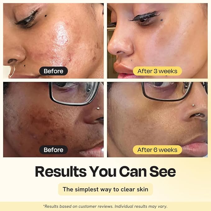 Gleamin Vitamin C Clay Mask for Dark Spots, Turmeric Clay Face Mask Skin Care, Deeply Cleanses & Refines Pores, Brightens Uneven Tone and Helps Improve Post-Blemish Scarring & Texture - 5 Oz