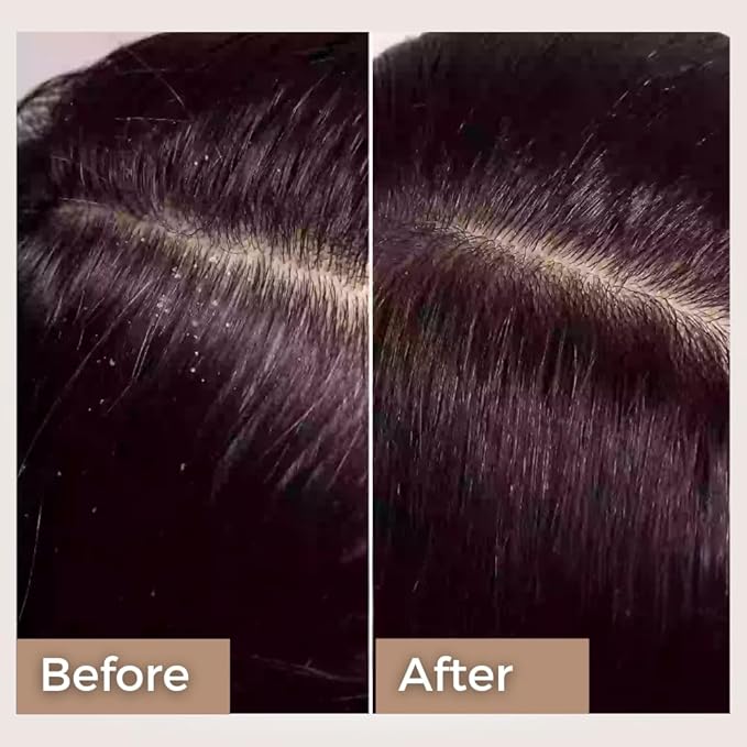 The Tribe Concepts Rosemary Anti Dandruff Hair Oil - Strengthens Hair, Itchy Flakes Scalp, Dandruff Remover with Rosemary, Ginger, Fenugreek, Pippali for Men Women 100 ml Pack of 1 Gold