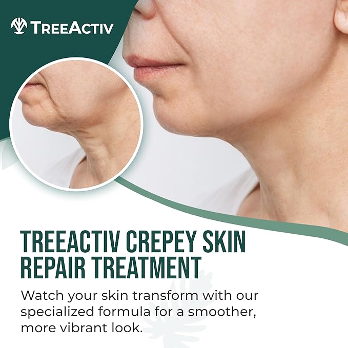 TreeActiv Crepey Skin Repair Treatment, 8oz, Firming Cream with Hyaluronic Acid & Shea Butter to Deeply Moisturize & Tighten Wrinkly Dry Crepe Skin, 500+ Uses