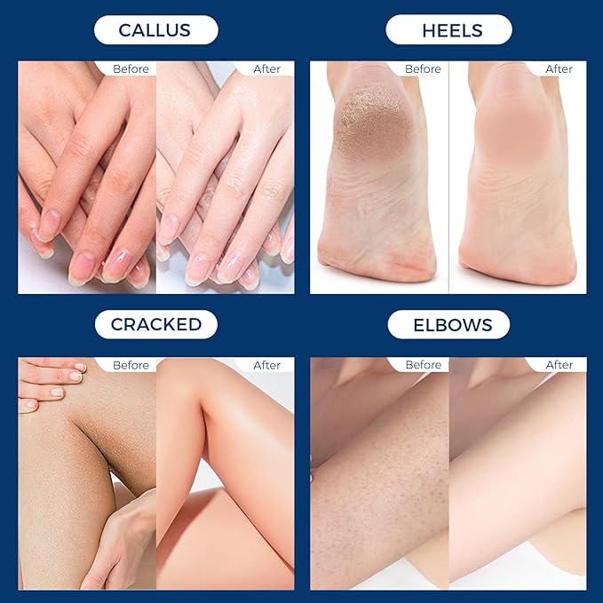 OUKEYA Urea Cream 42% plus Salicylic Acid 2% Net 350g Foot & Hand Cream for Dry Cracked, Urea Lotion for Feet Maximum Strength, 2 Pack