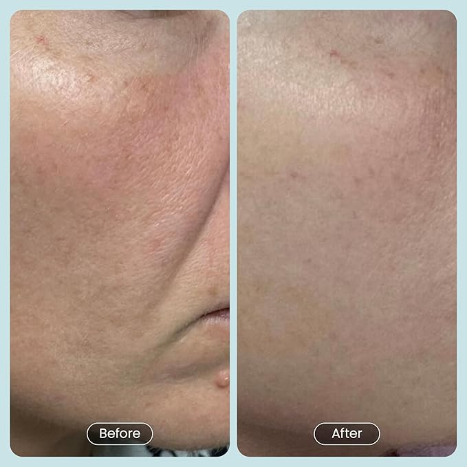 30 DAY MIRACLE BHA 20% Peeling Solution - Clinical Strength BHA Liquid Exfoliant for Clogged Pores, Wrinkles & Blackhead Remover - Salicylic Acid Serum & Chemical Exfoliant for Face Peel 1oz