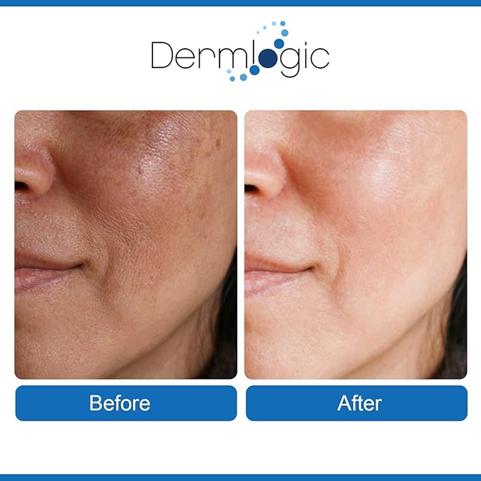 Anti Aging Resurfacing Peel Pads- Triple Action Chemical Peel Pads Combined with Glycolic, Lactic, and Salicylic Acids. Smooth’s Fine Lines, Wrinkles, Dark Spots, and Imperfections to Enhance the Skin