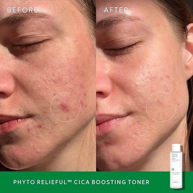 THANKYOU FARMER Phyto Relieful CICA PHA LHA Boosting Toner 7.03 fl oz (200ml), Dermatologist Tested, Alcohol-Free Liquid Exfoliant for Face, Oil-Free Hydrating Toner, Vegan, Fragrance-Free