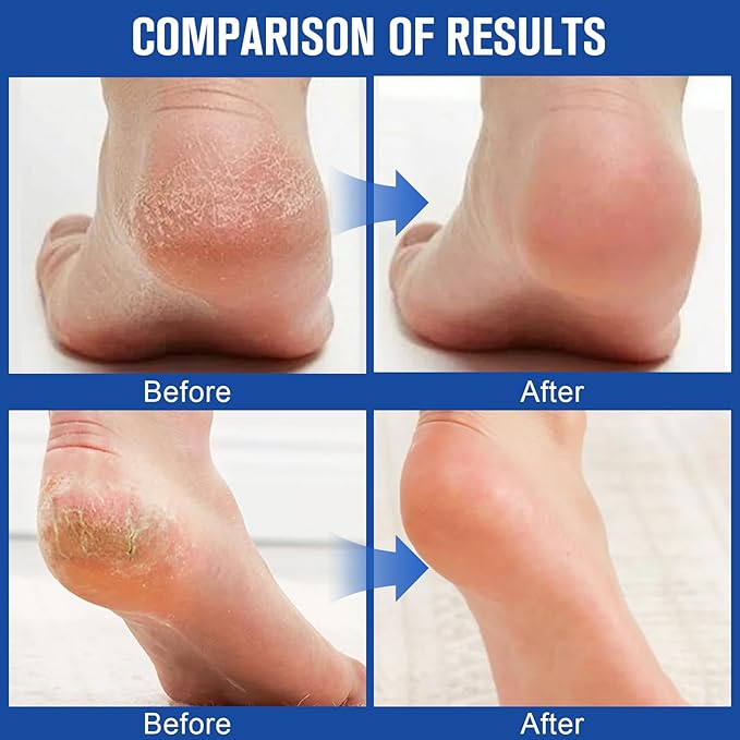 60% Urea Cream + 2% Saliculic Acid, 60 Percent for Feet Maximum Strength Cream, Moisturizing & Nourishing Hand & Foot Skin, for Extremely Dry Skin Foot & Body Lotion (3PCS)