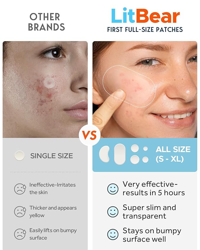 LitBear Large Acne Pimple Patches, 6 Sizes 100 Patches for Large Breakouts, Acne Patches for Face, Chin or Body, Acne Spot Treatment with Tea Tree & Calendula Oil, Hydrocolloid Bandages for Acne Skin