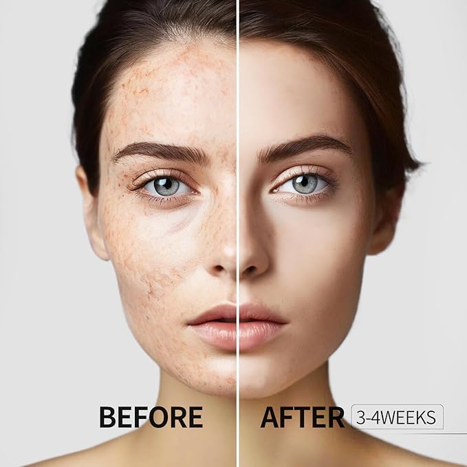 HANYWIL Dark Spot Remover for Face and Body, Dark Spot Corrector Serum, Age Spot Sun Spot Freckles Brown Spot Remover, Melasma Treatment, Skin Care Face Serum with Roller (0.5 Fl Oz)