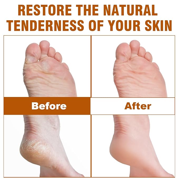 60% Urea Foot Cream with 2% Salicylic Acid for Dry Cracked Heels, Organic Tea Tree Feet Callus Repair Lotion, Maximum Strength Moisturizer with Hyaluronic Acid & Ceramides for Dry, Rough Skin