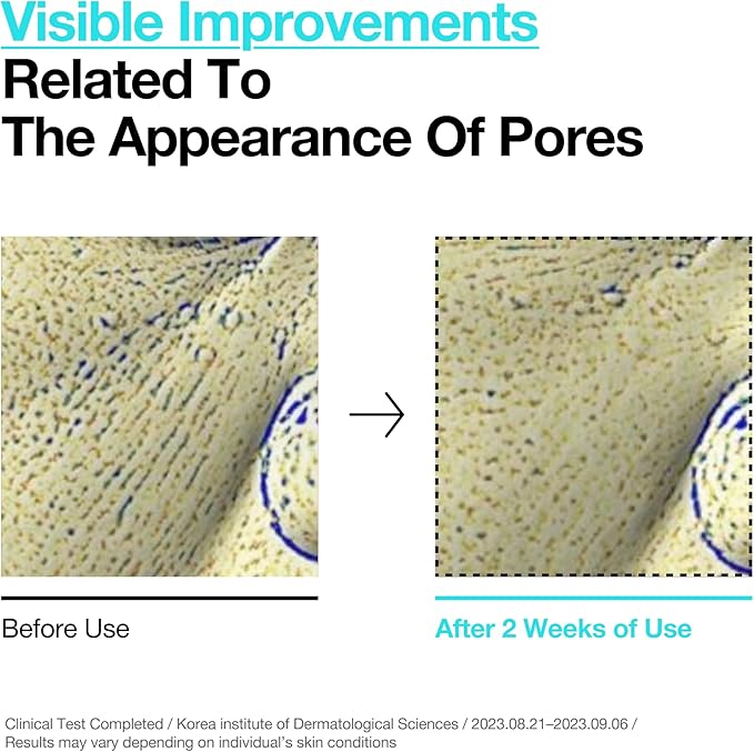 ANUA BHA 2% Gentle Exfoliating Toner, Mild Facial Exfoliant, Salicylic Acid for Pores and Sebum, Teatree Extract, Hyaluronic Acid, Ceramides (150ml / 5.07 fl.oz.)