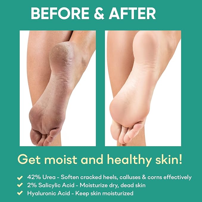 42% Urea Gel Max Plus Salicylic & Hyaluronic Acid - cracked heel repair callus remover gel for Elbows, Feet, and Hands, and cracked heel, calloused feet remover gel 4oz