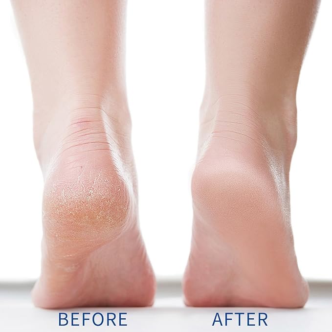 Urea Cream 40%, for Dry Cracked Feet, Heels, Knees, Elbows, Calluses and Hand Repair Care, Foot Moisturizer, Dead Skin Remover, Foot Care Softener