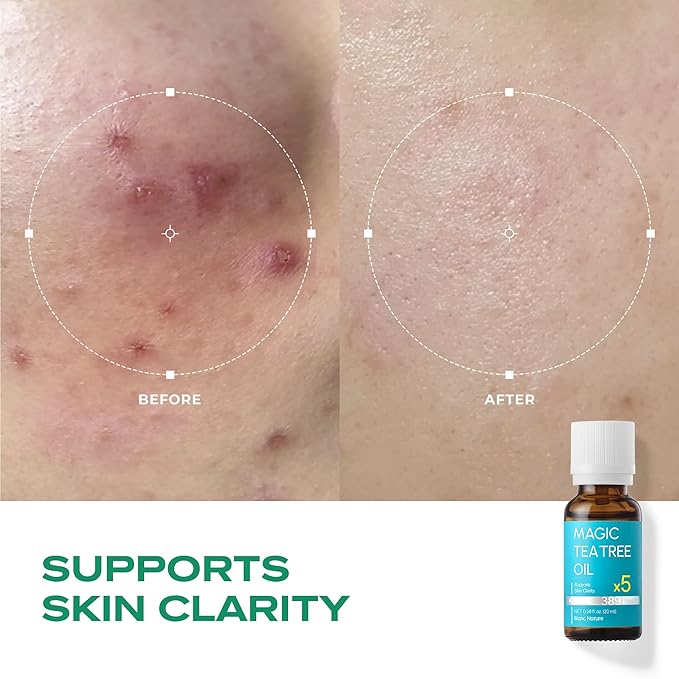 – Magic Tea Tree Oil for Face, Clarifying Facial Oil for Oily & Sensitive Skin, Lightweight Daily Care with Tea Tree, Skin-Balancing Vegan Korean Skincare, 0.7 fl oz