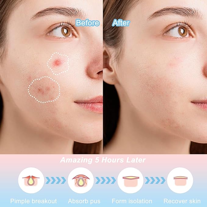 Pimple Patches,Pimple Patches for Face,Hydrocolloid Acne Patches, Pimple Patch Cute, Salicylic Acid &Tea Tree Oil,8 Unique Acne Patch Designs,148 Count