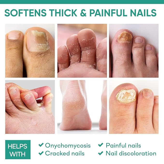 42% Urea Gel Max Plus Salicylic & Hyaluronic Acid - cracked heel repair callus remover gel for Elbows, Feet, and Hands, and cracked heel, calloused feet remover gel 4oz