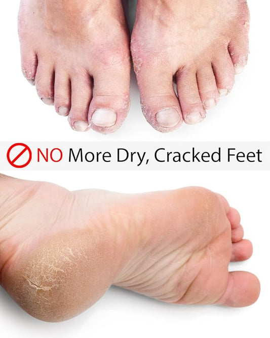 Eczema Foot Cream – Foot Eczema Treatment for Cracked Heels, Dry Feet and Rash Relief – Organic, Fragrance-Free, Hypoallergenic – Soothes Eczema, Psoriasis, Dermatitis – 4.5 oz