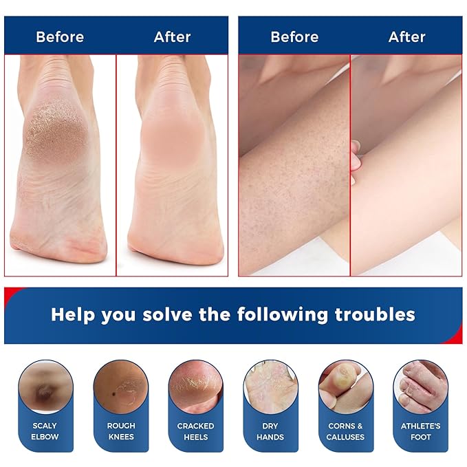 OUKEYA NEW FORMULA Urea Cream 40 Percent for Feet Maximum Strength, Hand Heels Dry Cracked Treatment Lotion for Knees & Elbows, Foot Dead Skin Cuticle Callus Remover Toenail Softener, 5.29 oz