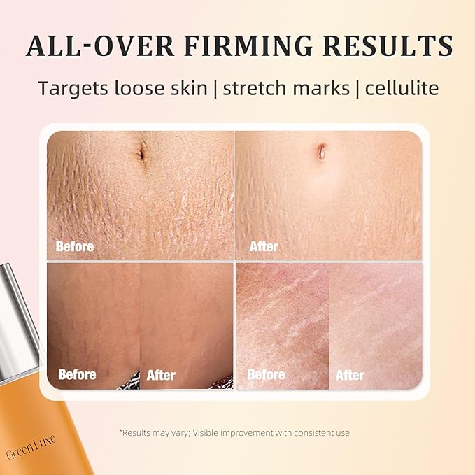 B Flat Belly Firming Cream – Skin Tightening Cream for Body: Lift & Tone Tummy, Thighs, Booty & Arms – Stretch Mark & Cellulite Sculpting Lotion for Women – 3.38 Fl Oz