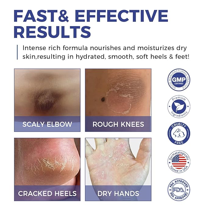 OUKEYA Urea Cream 42 Percent For Feet Plus 2% Salicylic Acid 5.29 oz, Foot Cream and Hand Cream Maximum Strength Intensive Repair Treatment, 3 Pack