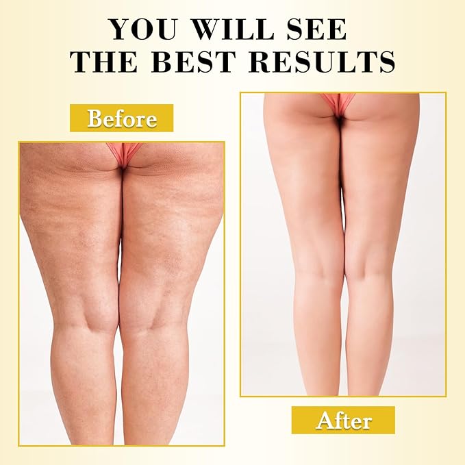 Anti Cellulite Massage Oil with Massager, Collagen and Stem Cell Skin Tightening Oil Natural Cellulite Remover Therapy Oil for Cellulite & Stretch Mark(Anti Cellulite Massage Oil Kit)