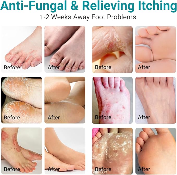 Athletes Foot Treatment Cream, Maximum Strength for Athlete's Foot (Tinea Pedis), Itching, Blister, Burning, Cracking, Scaling, Beriberi,Natural Herbs Antifungal Foot Cream (2-Pack)