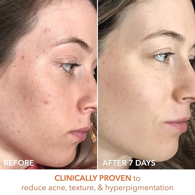 Dr. Dennis Gross Alpha Beta Universal Daily Peel: for Uneven Tone or Texture and Fine Lines or Enlarged Pores, (60 Treatments)