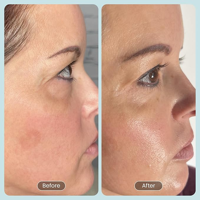 30 DAY MIRACLE BHA 20% Peeling Solution - Clinical Strength BHA Liquid Exfoliant for Clogged Pores, Wrinkles & Blackhead Remover - Salicylic Acid Serum & Chemical Exfoliant for Face Peel 1oz