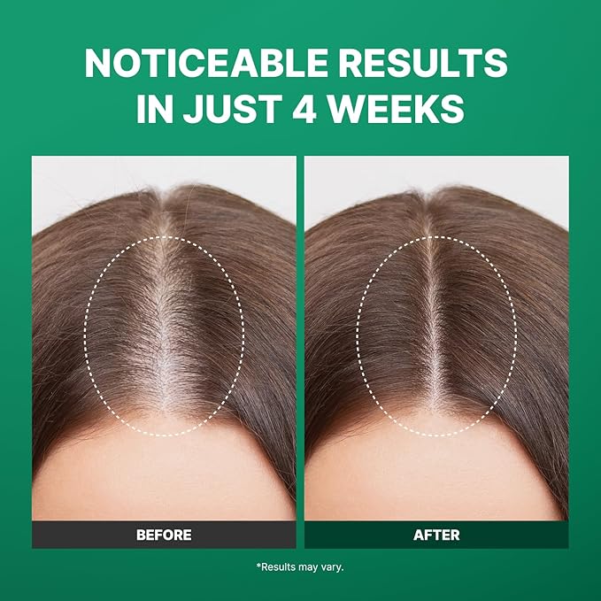 Spicule Microneedling Exosome Hair Growth Serum, Hair Loss Treatments for Women and Men, Peppermint Oil Cooling Scalp Serum, Menthol, Korean Hair Care (0.5 fl oz / 15ml)