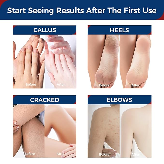 OUKEYA Urea Cream 42 Percent with 2% Salicylic Acid Tube 3 Oz, Urea Foot & Hand Cream for Dry Cracked, 40 per Urea Lotion for Feet Maximum Strength