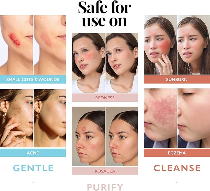 Hypochlorous Acid Spray for Face and Skin | Piercing Aftercare Spray | 4 oz Hypochlorous Acid Sprays for Face, Skin, Acne, Eczema, Body Acne Sprays, Piercing Aftercare, Facial Wound Solution, Workout