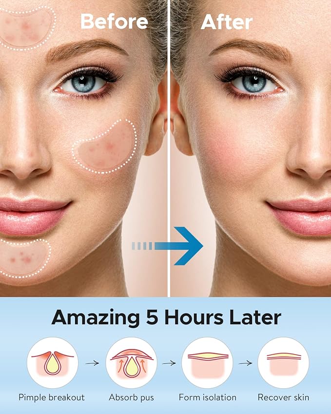 LitBear Acne Patches Large, Hydrocolloid Pimple Patches for Breakouts, Zit and Blemish, Large Acne Patches for Face, Chin, Back and Body with Tea Tree & Calendula Oil