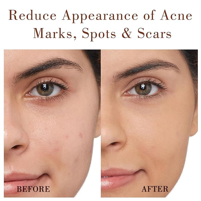 100% Pure Natural Rosehip Oil for Face, USDA Certified Organic, Cold Pressed, Extra Virgin, Hexane Free Rosehip Seed Oil for Anti-Aging, Acne Scar Treatment, Skin & Hair Care (4.22 oz/125 ml)